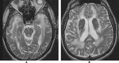 what is cerebral autosomal dominant arteriopathy